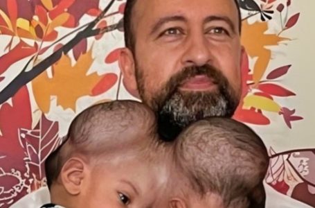 The Incredible Journey of Conjoined Twins Sharing Brain Tissue After a Risky Surgery!: See How They Look Now!
