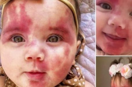 Baby Called ‘Hideous’ and ‘Defective’ Stuns Everyone With Her Incredible Transformation!: See The Photos!