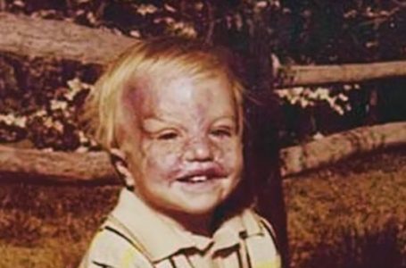 Toddler Survives Horrific Burns and Inspires with His Transformation!: See The Photos!