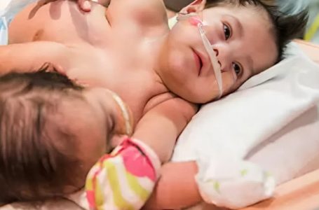 The Incredible Story of Conjoined Twins Who Beat the Odds!: What Do They Look Like Now?